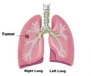 lung-tumor image